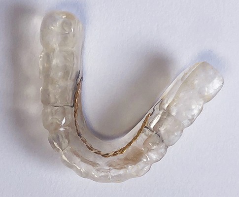 Occlusal splint used for T M J treatment